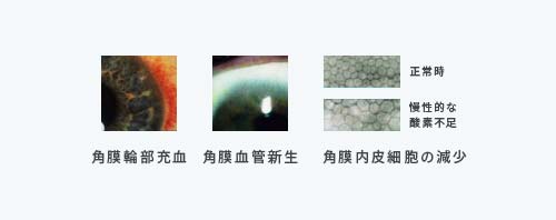 角膜輪部充血、角膜血管新生、角膜内皮細胞の減少の症例写真