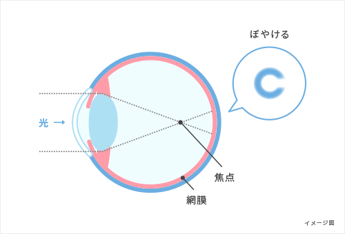 近視のしくみ図解