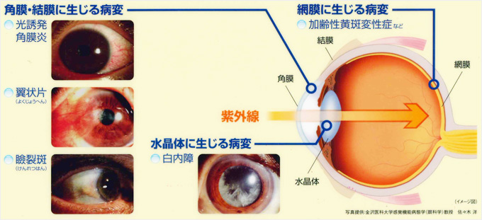 紫外線が原因となる可能性がある眼病