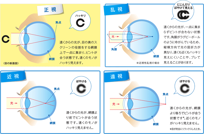 強度角膜乱視: 乱視の見え方 – YWGSR